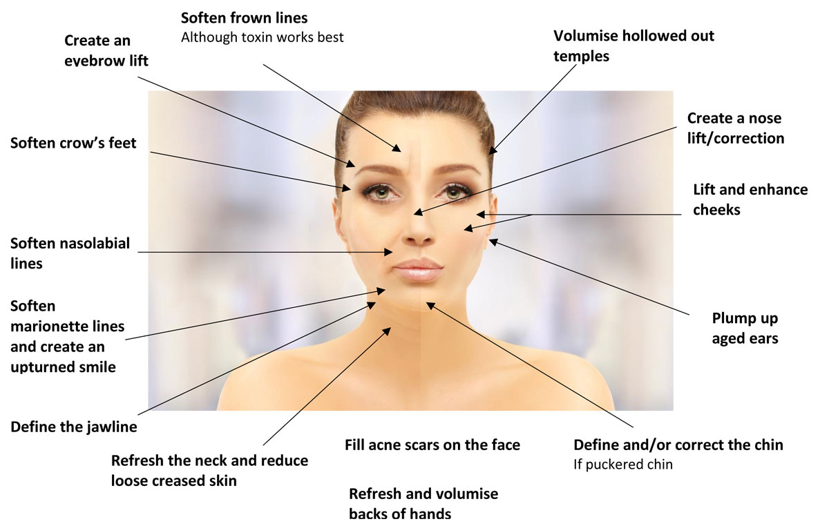 Diagram of areas that Dermal Bio-stimulators can be used to treat