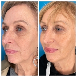 The magic thread lift